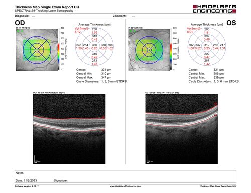 Albinism and Renal failure - Possible Hermansky-Pudlak Syndrome
65 year old female with foveal hypoplasia and renal failure since age 18.  VA 20/40 OD, 20/63 OS
