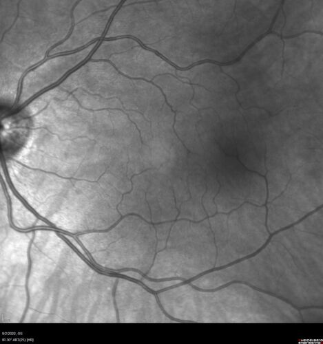 Oculocutaneous albinism
62 year old female.  Testing shows an absence of a fovea.  Vision was 20/50 and she has nystagmus.
