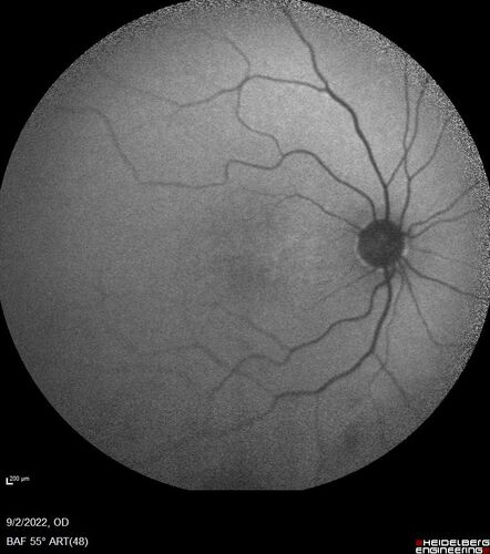Oculocutaneous albinism
62 year old female.  Testing shows an absence of a fovea.  Vision was 20/50 and she has nystagmus.

