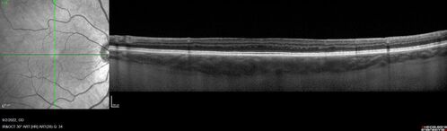Oculocutaneous albinism
62 year old female.  Testing shows an absence of a fovea.  Vision was 20/50 and she has nystagmus.
