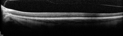Oculocutaneous albinism
62 year old female.  Testing shows an absence of a fovea.  Vision was 20/50 and she has nystagmus.
