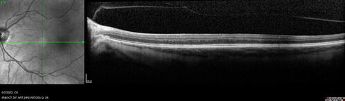 Oculocutaneous albinism
62 year old female.  Testing shows an absence of a fovea.  Vision was 20/50 and she has nystagmus.
