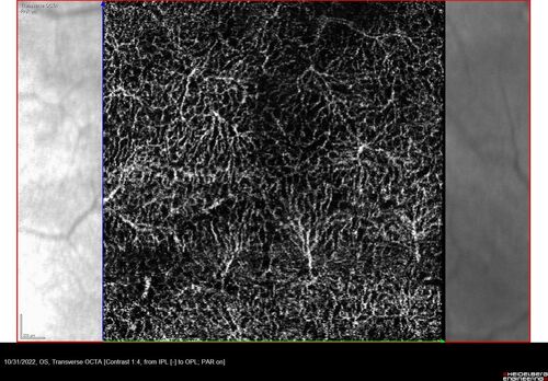 Oculocutaneous albinism
62 year old female.  Testing shows an absence of a fovea.  Vision was 20/50 and she has nystagmus.

