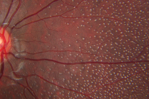 Fundus Albipunctatus
12 year old female with normal vision.  She has 4 siblings all of whom have either white spots or spots on IR.  Genetic testing by parents was deferred.
