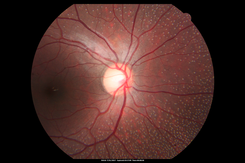 Fundus Albipunctatus
12 year old female with normal vision.  She has 4 siblings all of whom have either white spots or spots on IR.  Genetic testing by parents was deferred.
