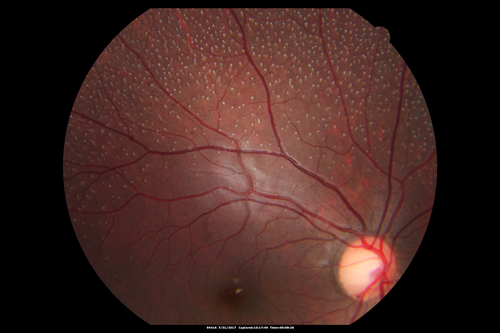 Fundus Albipunctatus
12 year old female with normal vision.  She has 4 siblings all of whom have either white spots or spots on IR.  Genetic testing by parents was deferred.
