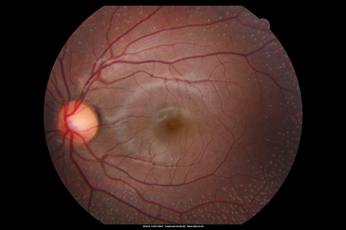 Fundus Albipunctatus
12 year old female with normal vision.  She has 4 siblings all of whom have either white spots or spots on IR.  Genetic testing by parents was deferred.
