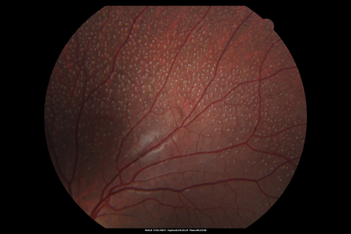 Fundus Albipunctatus
12 year old female with normal vision.  She has 4 siblings all of whom have either white spots or spots on IR.  Genetic testing by parents was deferred.
