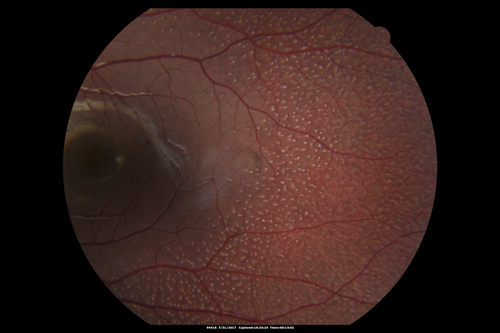 Fundus Albipunctatus
12 year old female with normal vision.  She has 4 siblings all of whom have either white spots or spots on IR.  Genetic testing by parents was deferred.
