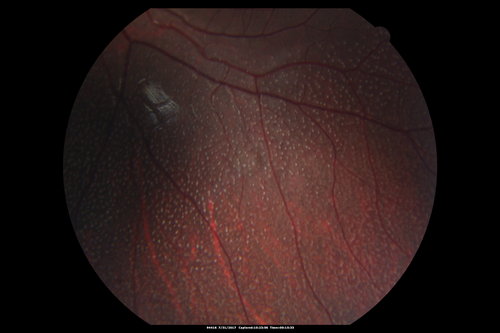 Fundus Albipunctatus
12 year old female with normal vision.  She has 4 siblings all of whom have either white spots or spots on IR.  Genetic testing by parents was deferred.
