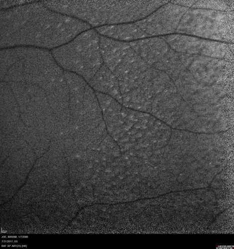Fundus Albipunctatus
12 year old female with normal vision.  She has 4 siblings all of whom have either white spots or spots on IR.  Genetic testing by parents was deferred.
