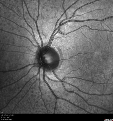 Fundus Albipunctatus
12 year old female with normal vision.  She has 4 siblings all of whom have either white spots or spots on IR.  Genetic testing by parents was deferred.
