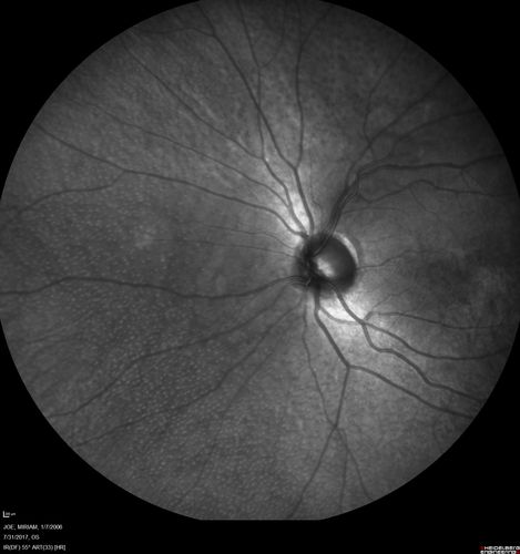 Fundus Albipunctatus
12 year old female with normal vision.  She has 4 siblings all of whom have either white spots or spots on IR.  Genetic testing by parents was deferred.
