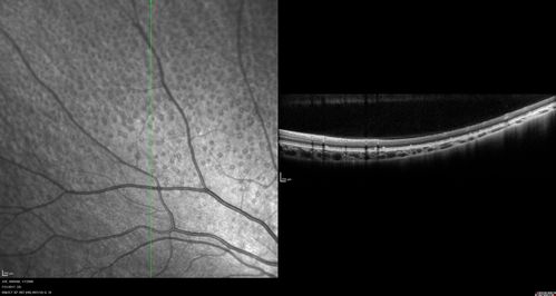 Fundus Albipunctatus
12 year old female with normal vision.  She has 4 siblings all of whom have either white spots or spots on IR.  Genetic testing by parents was deferred.
