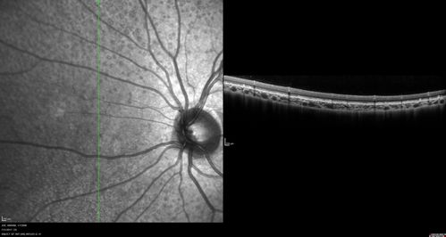 Fundus Albipunctatus
12 year old female with normal vision.  She has 4 siblings all of whom have either white spots or spots on IR.  Genetic testing by parents was deferred.
