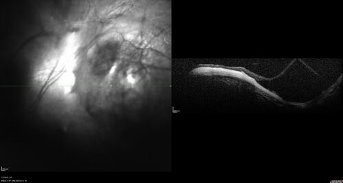 Staphyloma and Atrophy with Vitreoretinal traction
Only eye of patient with Albinism and decreasing vision now 5/200 in this 72 year old man.  There is myopic tractional maculopathy.  The patient also has albinism by history.
