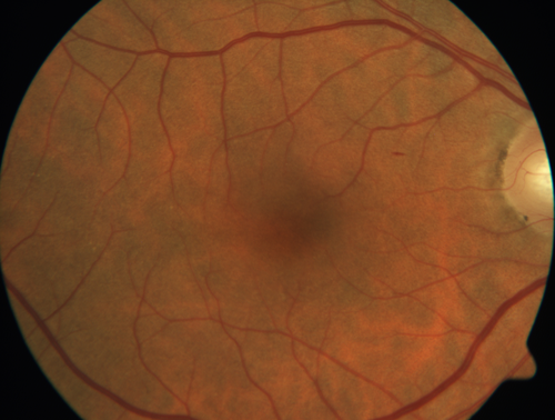 Normal Right eye
67 year old female with CSR in the left eye first 20 years ago.  She was managed with out therapy and has had a few episodes since.  Now ther eis distortion in the left eye for a few days.  She had a steroid shot in her shoulder 5 months ago.
VA 20/20 OD, 20/50 OS
