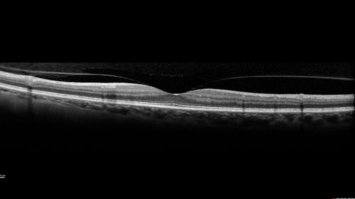 Choroidal Neovascular Membrane following Prior Central Serous Chorioretinopathy - OCT-A
67 year old female with CSR in the left eye first 20 years ago.  She was managed with out therapy and has had a few episodes since.  Now ther eis distortion in the left eye for a few days.  She had a steroid shot in her shoulder 5 months ago.
VA 20/20 OD, 20/50 OS- ICG and OCT-A confirm CNVM in the left eye

