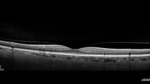 Normal Right eye
67 year old female with CSR in the left eye first 20 years ago.  She was managed with out therapy and has had a few episodes since.  Now ther eis distortion in the left eye for a few days.  She had a steroid shot in her shoulder 5 months ago.
VA 20/20 OD, 20/50 OS

