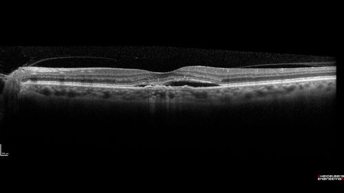 Choroidal Neovascular Membrane following Prior Central Serous Chorioretinopathy - OCT-A
67 year old female with CSR in the left eye first 20 years ago.  She was managed with out therapy and has had a few episodes since.  Now ther eis distortion in the left eye for a few days.  She had a steroid shot in her shoulder 5 months ago.
VA 20/20 OD, 20/50 OS- ICG and OCT-A confirm CNVM in the left eye
