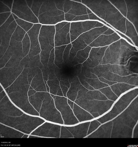 Normal Right eye
67 year old female with CSR in the left eye first 20 years ago.  She was managed with out therapy and has had a few episodes since.  Now ther eis distortion in the left eye for a few days.  She had a steroid shot in her shoulder 5 months ago.
VA 20/20 OD, 20/50 OS
