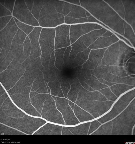 Normal Right eye
67 year old female with CSR in the left eye first 20 years ago.  She was managed with out therapy and has had a few episodes since.  Now ther eis distortion in the left eye for a few days.  She had a steroid shot in her shoulder 5 months ago.
VA 20/20 OD, 20/50 OS
