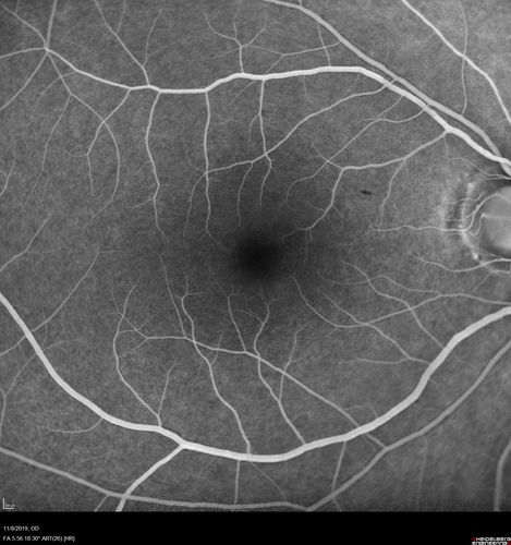 Normal Right eye
67 year old female with CSR in the left eye first 20 years ago.  She was managed with out therapy and has had a few episodes since.  Now ther eis distortion in the left eye for a few days.  She had a steroid shot in her shoulder 5 months ago.
VA 20/20 OD, 20/50 OS
