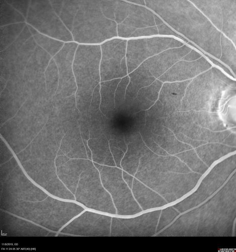 Choroidal Neovascular Membrane following Prior Central Serous Chorioretinopathy - OCT-A
67 year old female with CSR in the left eye first 20 years ago.  She was managed with out therapy and has had a few episodes since.  Now ther eis distortion in the left eye for a few days.  She had a steroid shot in her shoulder 5 months ago.
VA 20/20 OD, 20/50 OS- ICG and OCT-A confirm CNVM in the left eye
