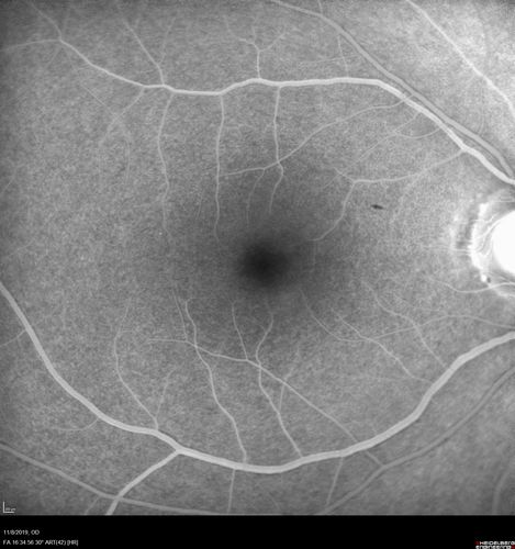 Normal Right eye
67 year old female with CSR in the left eye first 20 years ago.  She was managed with out therapy and has had a few episodes since.  Now ther eis distortion in the left eye for a few days.  She had a steroid shot in her shoulder 5 months ago.
VA 20/20 OD, 20/50 OS
