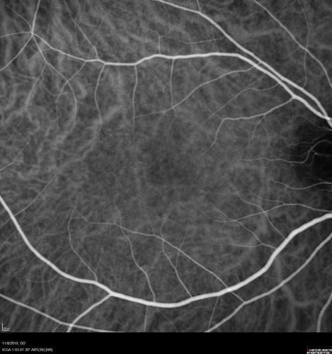 Normal Right eye
67 year old female with CSR in the left eye first 20 years ago.  She was managed with out therapy and has had a few episodes since.  Now ther eis distortion in the left eye for a few days.  She had a steroid shot in her shoulder 5 months ago.
VA 20/20 OD, 20/50 OS

