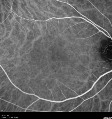 Normal Right eye
67 year old female with CSR in the left eye first 20 years ago.  She was managed with out therapy and has had a few episodes since.  Now ther eis distortion in the left eye for a few days.  She had a steroid shot in her shoulder 5 months ago.
VA 20/20 OD, 20/50 OS

