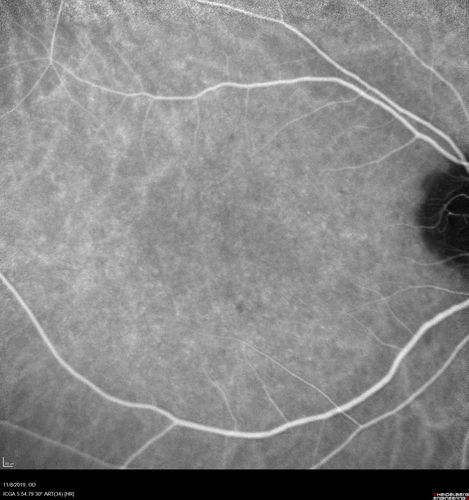 Normal Right eye
67 year old female with CSR in the left eye first 20 years ago.  She was managed with out therapy and has had a few episodes since.  Now ther eis distortion in the left eye for a few days.  She had a steroid shot in her shoulder 5 months ago.
VA 20/20 OD, 20/50 OS
