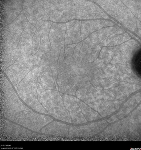 Normal Right eye
67 year old female with CSR in the left eye first 20 years ago.  She was managed with out therapy and has had a few episodes since.  Now ther eis distortion in the left eye for a few days.  She had a steroid shot in her shoulder 5 months ago.
VA 20/20 OD, 20/50 OS

