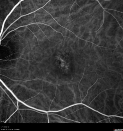 Choroidal Neovascular Membrane following Prior Central Serous Chorioretinopathy - OCT-A
67 year old female with CSR in the left eye first 20 years ago.  She was managed with out therapy and has had a few episodes since.  Now ther eis distortion in the left eye for a few days.  She had a steroid shot in her shoulder 5 months ago.
VA 20/20 OD, 20/50 OS- ICG and OCT-A confirm CNVM in the left eye

