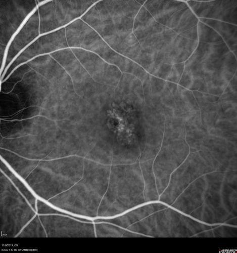 Choroidal Neovascular Membrane following Prior Central Serous Chorioretinopathy - OCT-A
67 year old female with CSR in the left eye first 20 years ago.  She was managed with out therapy and has had a few episodes since.  Now ther eis distortion in the left eye for a few days.  She had a steroid shot in her shoulder 5 months ago.
VA 20/20 OD, 20/50 OS- ICG and OCT-A confirm CNVM in the left eye
