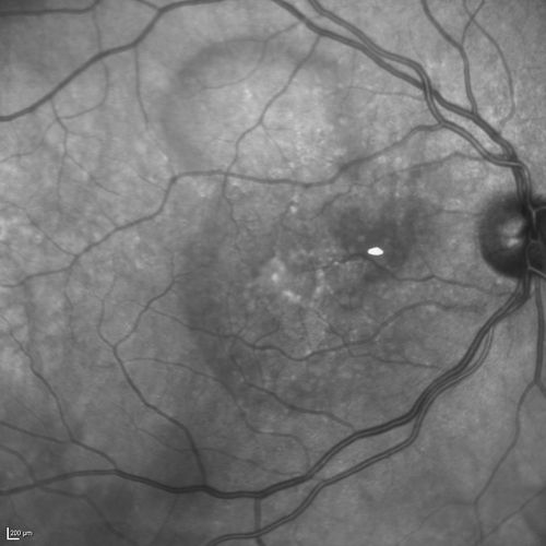 Cartwheel CNVM - Classic - wet AMD - evidence of possible old CSR
75 y.o Decreased Vision right eye for one year.   VA OD: sc20/125+2 OS 20/25.  Autofluorescence and SD OCT show evidence of old serous retinal detachment superior to the fovea suggesting a history of CSR.  The macular lesion on FA shows a classic cartwheel appearance
