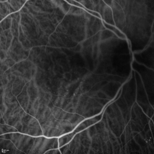 Cartwheel CNVM - Classic - wet AMD - evidence of possible old CSR - ICG is normal - shows nothing
75 y.o Decreased Vision right eye for one year.   VA OD: sc20/125+2 OS 20/25.  Autofluorescence and SD OCT show evidence of old serous retinal detachment superior to the fovea suggesting a history of CSR.  The macular lesion on FA shows a classic cartwheel appearance
