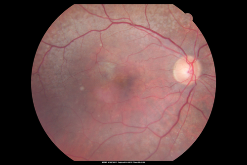 Asymptomatic wet AMD - Subfoveal CNM both eyes
82 year old woman - 20/25 OU. Images show occult subfoveal CNVM both eyes best seen on late ICG.  The left eye also has probable polypoidal choroidal vasculopathy.  No treatment was recommended on the first visit - follow-up at 1 month.
