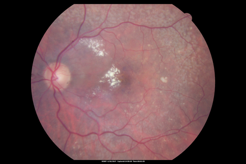 Asymptomatic wet AMD - Subfoveal CNM both eyes
82 year old woman - 20/25 OU. Images show occult subfoveal CNVM both eyes best seen on late ICG.  The left eye also has probable polypoidal choroidal vasculopathy.  No treatment was recommended on the first visit - follow-up at 1 month.
