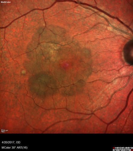 Asymptomatic wet AMD - Subfoveal CNM both eyes
82 year old woman - 20/25 OU. Images show occult subfoveal CNVM both eyes best seen on late ICG.  The left eye also has probable polypoidal choroidal vasculopathy.  No treatment was recommended on the first visit - follow-up at 1 month.
