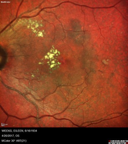 Asymptomatic wet AMD - Subfoveal CNM both eyes
82 year old woman - 20/25 OU. Images show occult subfoveal CNVM both eyes best seen on late ICG.  The left eye also has probable polypoidal choroidal vasculopathy.  No treatment was recommended on the first visit - follow-up at 1 month.
