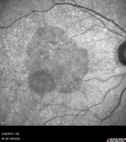 Asymptomatic wet AMD - Subfoveal CNM both eyes
82 year old woman - 20/25 OU. Images show occult subfoveal CNVM both eyes best seen on late ICG.  The left eye also has probable polypoidal choroidal vasculopathy.  No treatment was recommended on the first visit - follow-up at 1 month.
