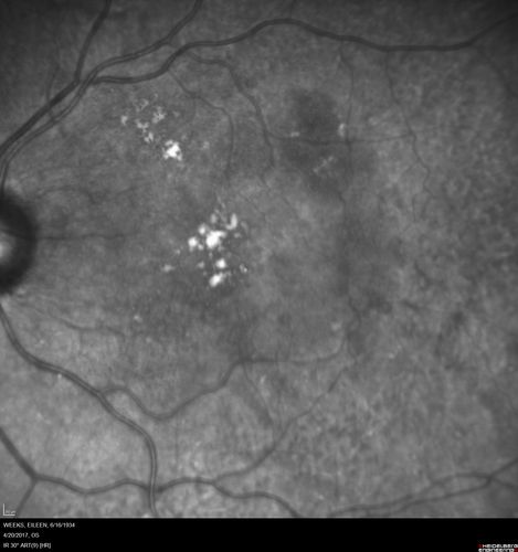 Asymptomatic wet AMD - Subfoveal CNM both eyes
82 year old woman - 20/25 OU. Images show occult subfoveal CNVM both eyes best seen on late ICG.  The left eye also has probable polypoidal choroidal vasculopathy.  No treatment was recommended on the first visit - follow-up at 1 month.
