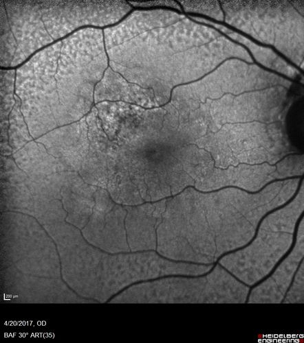 Asymptomatic wet AMD - Subfoveal CNM both eyes
82 year old woman - 20/25 OU. Images show occult subfoveal CNVM both eyes best seen on late ICG.  The left eye also has probable polypoidal choroidal vasculopathy.  No treatment was recommended on the first visit - follow-up at 1 month.
