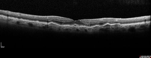Asymptomatic wet AMD - Subfoveal CNM both eyes
82 year old woman - 20/25 OU. Images show occult subfoveal CNVM both eyes best seen on late ICG.  The left eye also has probable polypoidal choroidal vasculopathy.  No treatment was recommended on the first visit - follow-up at 1 month.
