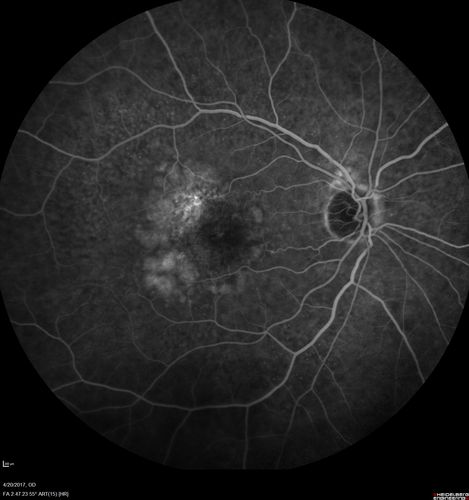 Asymptomatic wet AMD - Subfoveal CNM both eyes
82 year old woman - 20/25 OU. Images show occult subfoveal CNVM both eyes best seen on late ICG.  The left eye also has probable polypoidal choroidal vasculopathy.  No treatment was recommended on the first visit - follow-up at 1 month.
