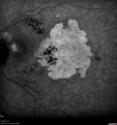 Asymptomatic wet AMD - Subfoveal CNM both eyes
82 year old woman - 20/25 OU. Images show occult subfoveal CNVM both eyes best seen on late ICG.  The left eye also has probable polypoidal choroidal vasculopathy.  No treatment was recommended on the first visit - follow-up at 1 month.

