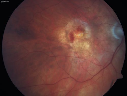 New wet AMD OS with subretinal hemorrhage and recent vision loss, Scar OD
