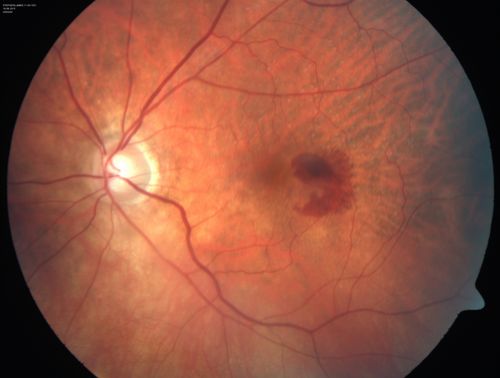 New wet AMD OS with subretinal hemorrhage and recent vision loss, Scar OD
