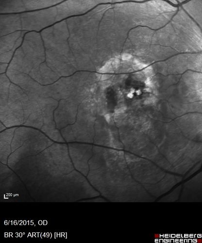 New wet AMD OS with subretinal hemorrhage and recent vision loss, Scar OD
